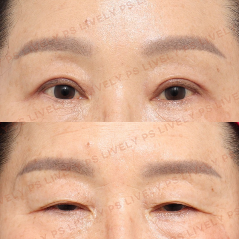 눈처짐수술, 상태에 따라 달라지는 수술 방법 | 상안검수술·눈썹하거상·이마거상 총정리