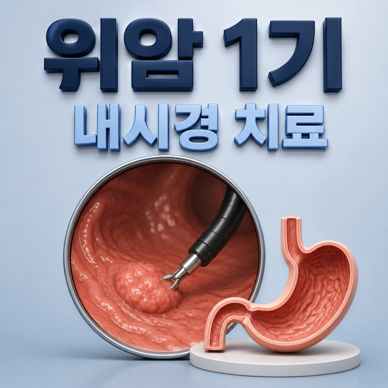 위암 1기, 내시경 치료만으로 끝날 수 있을까?