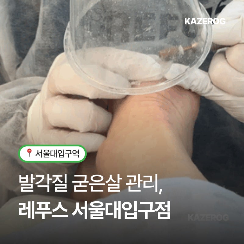 서울대입구발각질 관리 레푸스 발각질 내성발톱 굳은살 케어 후기