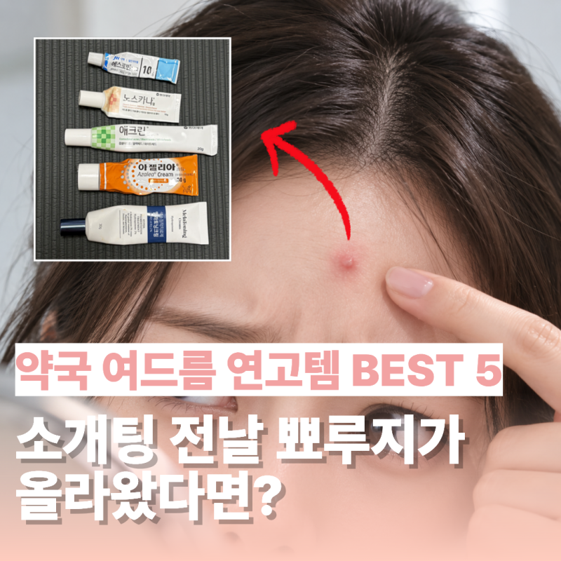 소개팅 전날 뾰루지 올라왔다면? 약국에서 찾아볼 여드름 연고템 5가지