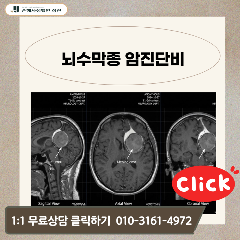 뇌수막종 암진단비, D32 양성 코드인데 전액 지급 가능할까?