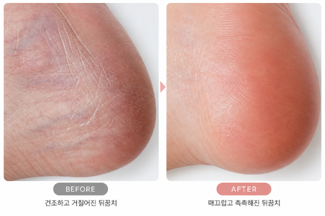 한미 유리아크림 약국템 구입한 후기,가격부터 발뒤꿈치 사용법까지