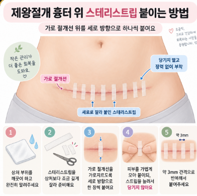 제왕절개 흉터관리 방법｜시카케어 메디폼 스테리스트립 아마존 직구 및 사용 후기