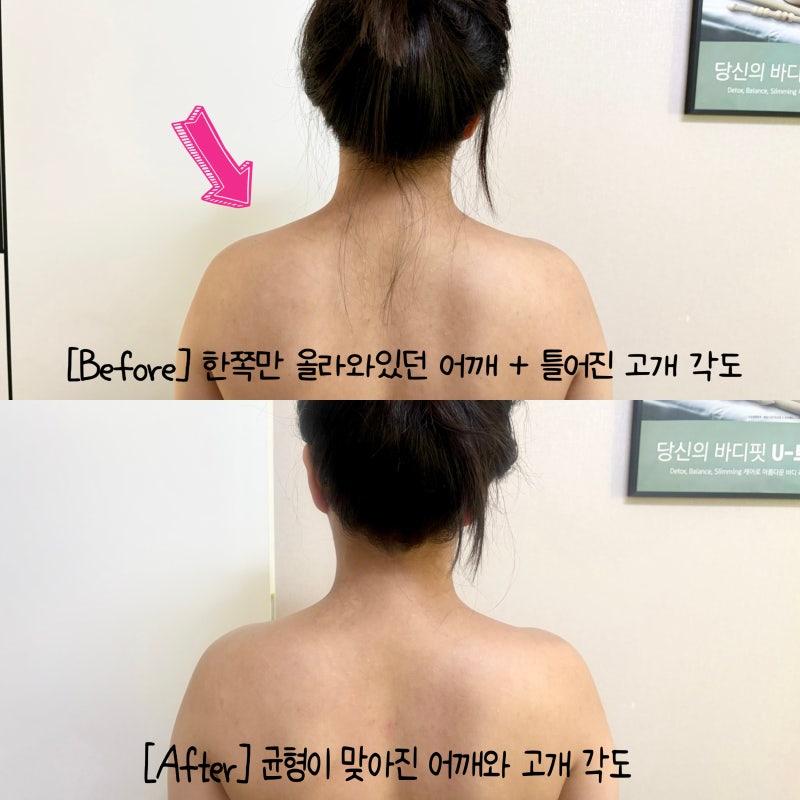 대전 문지동 바디관리 더휴스킨바디케어 거북목+라운드숄더 마사지 후기
