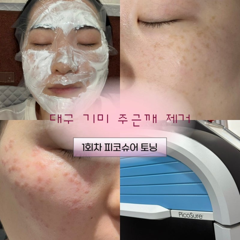 대구 기미 주근깨 잡티 제거 1회차 피코 슈어 레이저 토닝 가격 후기 내돈내산