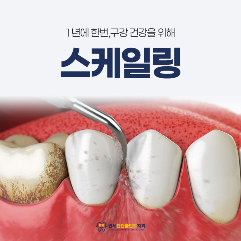 의정부 치과 추천 주기적인 스케일링의 중요성으로는