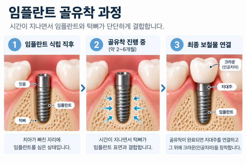 임플란트 골유착, 왜 3개월을 기다릴까? 안 아파도 치료가 끝난 게 아닙니다