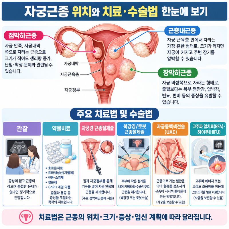 「자궁근종, 5cm면 수술해야 할까? 원인·증상부터 수술 기준과 최신 치료법까지 총정리」