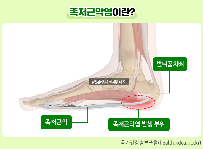 족저근막염, 대략 8개월째 마사지볼부터 나만의 노하우(Know-how) 공유.