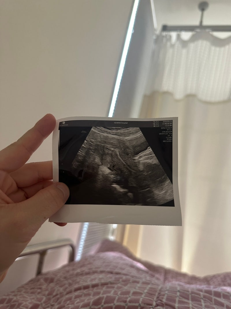 쌍둥이 임신 피검사 수치, 시험관 4일배양 1등급 배아 2개 신선이식 쌍둥이 임신 후기