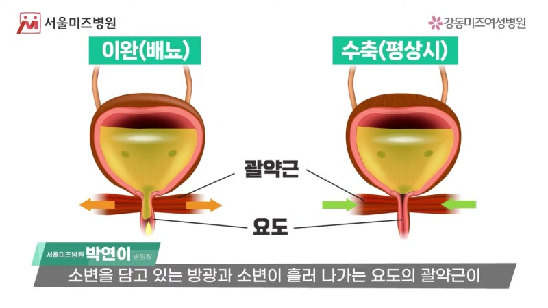 복압성 절박성 요실금, 치료법이 다릅니다