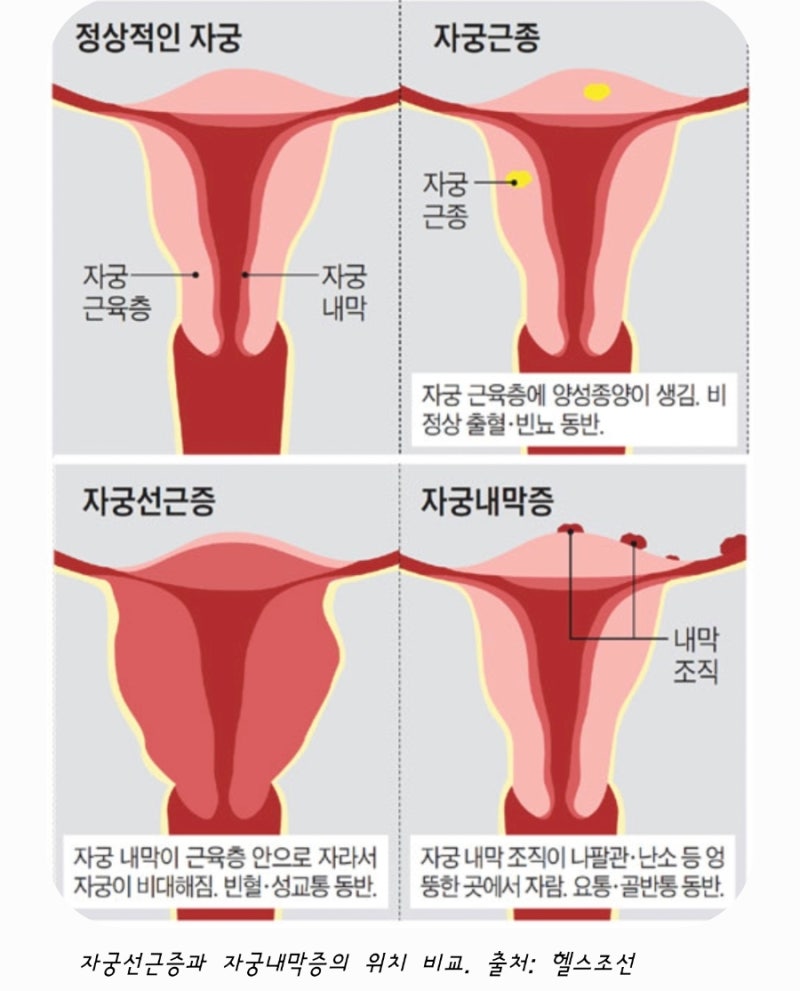 자궁선근증에 미레나? 알아보기