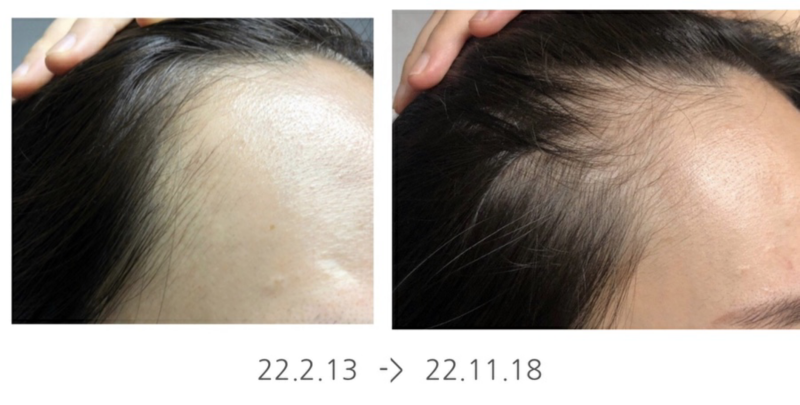 바이브랩 두피앰플 9개월 후기 최대 85% 할인 지금이 최저가?