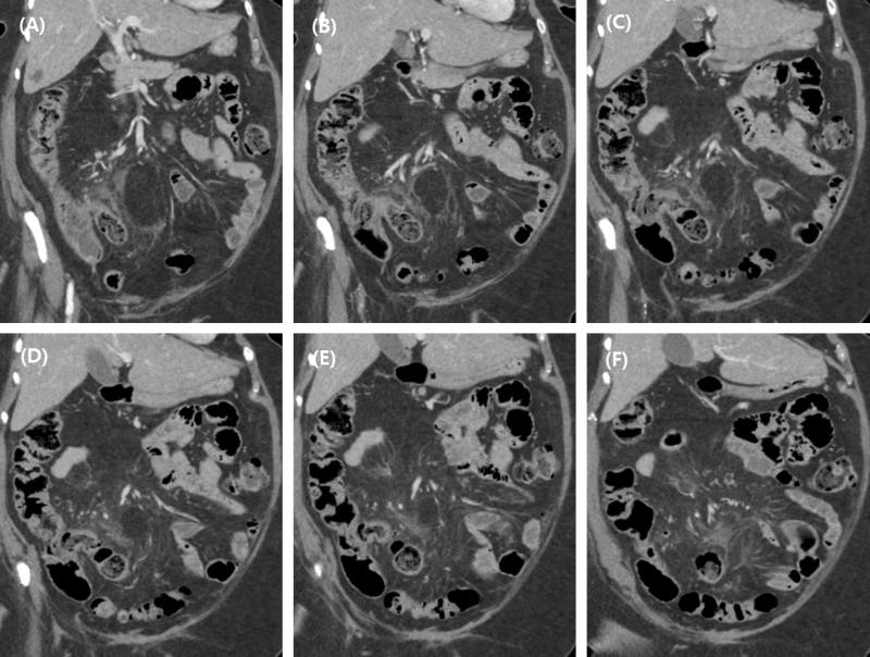 Case Study_1063-우측 하복부 통증이 있는 70대 후반 여성-말단 회장 게실염(Terminal ileal diverticulitis....