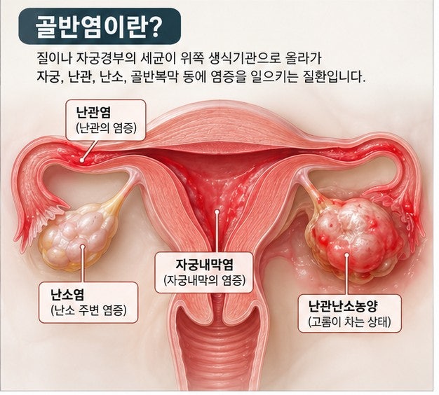 골반염 증상, 원인, 치료, 검사, 임신, 불임 가능성 등 총정리