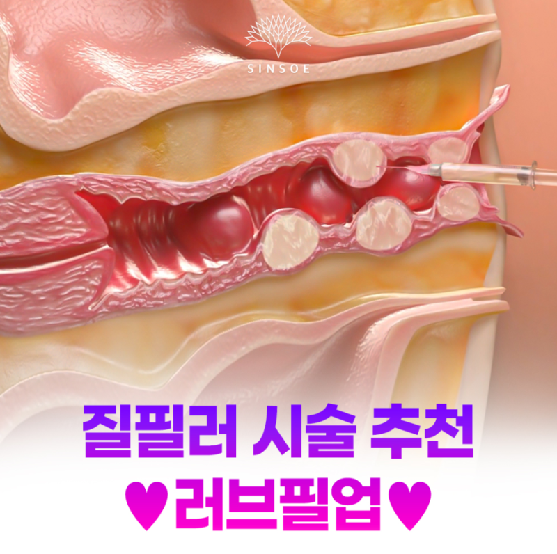 질필러 후 관계, 언제부터 가능하고 주의할 점은 무엇일까요?
