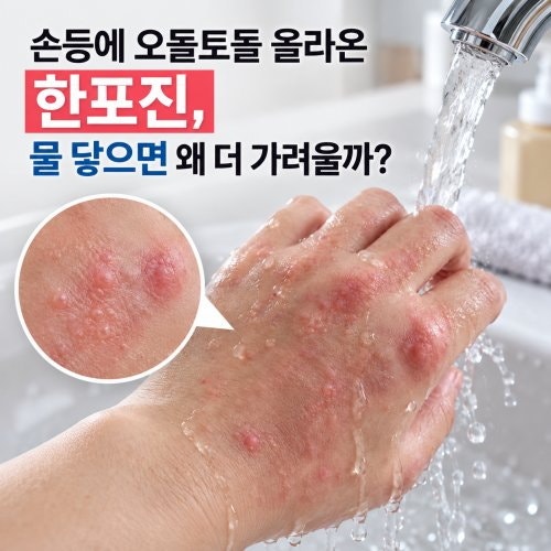 손등에 오돌토돌 올라온 한포진, 물 닿으면 왜 더 가려울까?