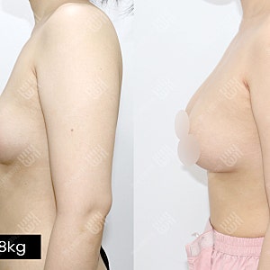 빼의원 가슴지방이식 A에서 풀B컵으로
