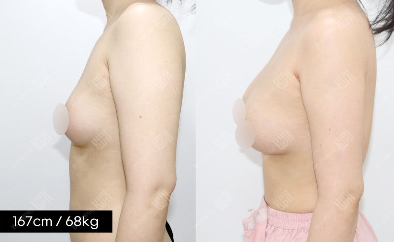 빼의원 가슴지방이식 A에서 풀B컵으로