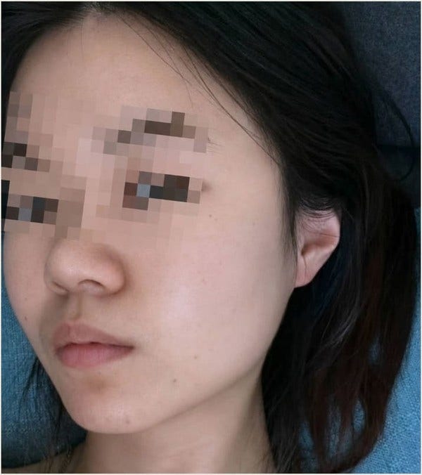 턱모낭염 한 달 관리 흐름