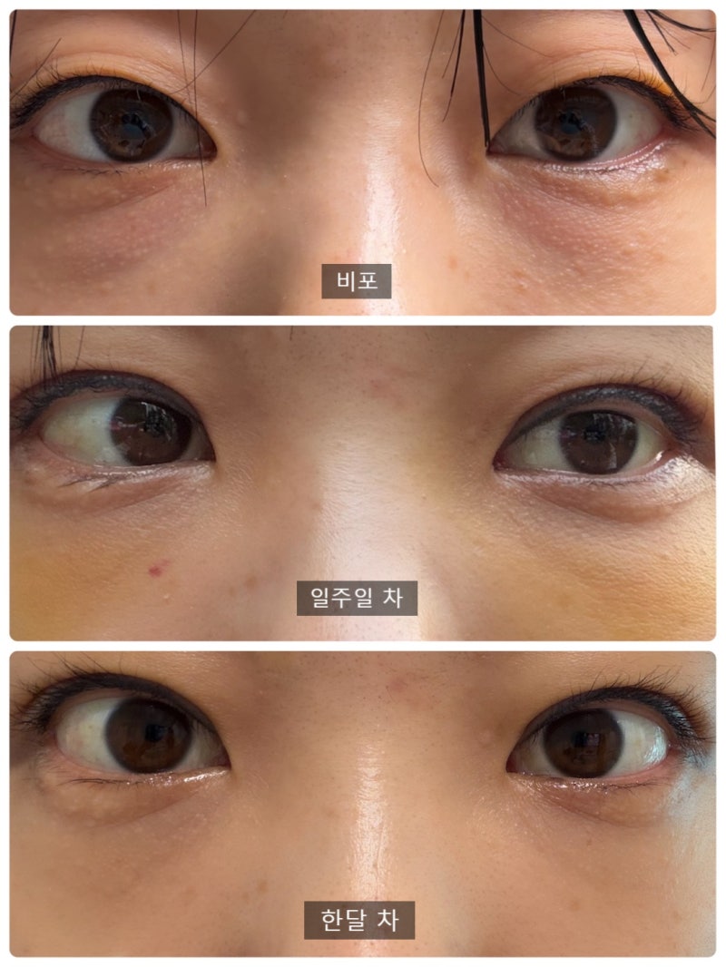 수유역성형외과에서 눈밑지방재배치 쌍수받은 1달차 후기 가격, 전후비교, 회복기간, 비용