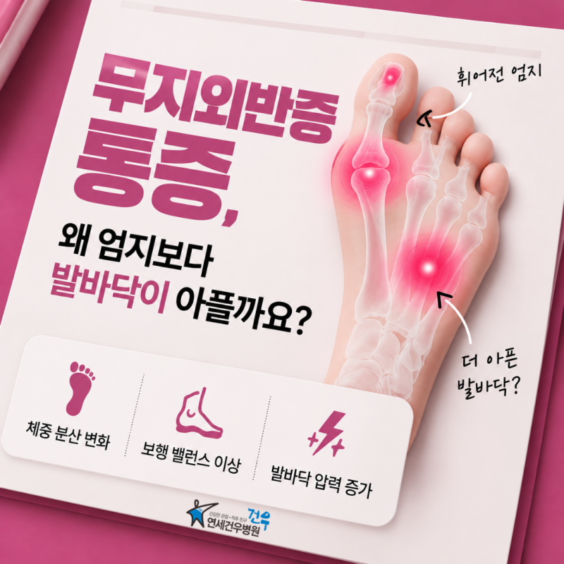 무지외반증 통증, 왜 엄지보다 발바닥이 아플까요?