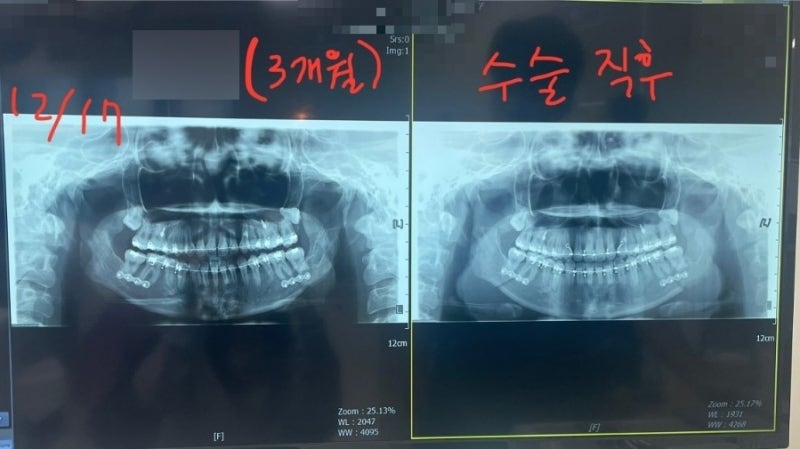 [대구 하악수술 후기 #3 ] 3급부정교합 | 경북대학교병원 하악수술 회복 과정 & 철판 제거 수술....