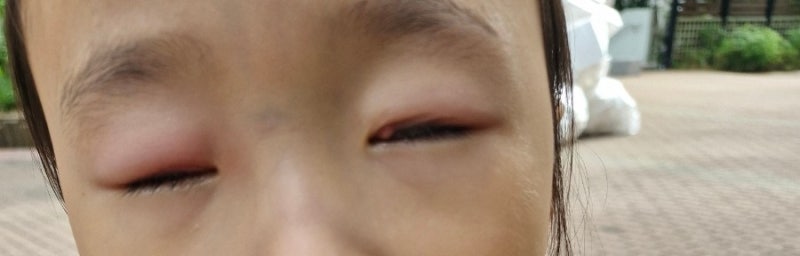 [아이 다래끼 수술 후기(2)] 겪고 싶지 않았던 재회...첫째 딸 오른쪽 눈 다래끼 수술 후기(증....