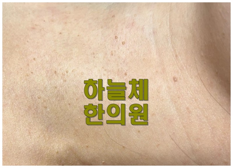 대전편평사마귀 화침과 레이저 제거 무엇이 다를까요?