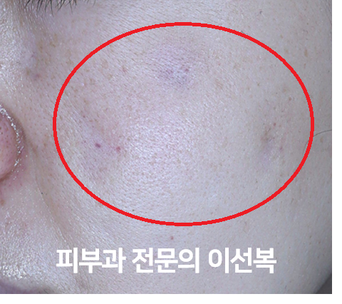 염증 주사 후에 피부가 패였다면, 어떻게 치료할까요 (패임 치료 전/후)