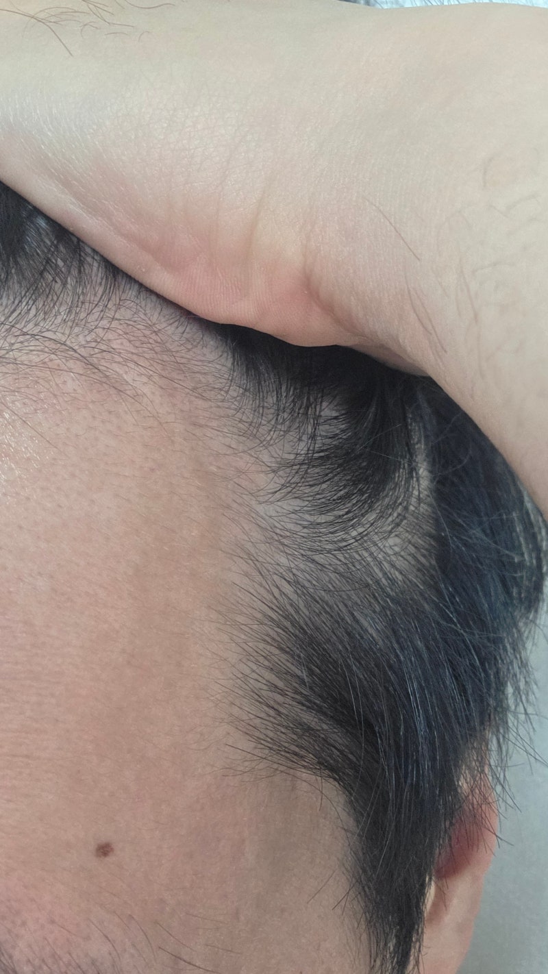 마이녹실 5% 폼 1개월 찐 사용 후기