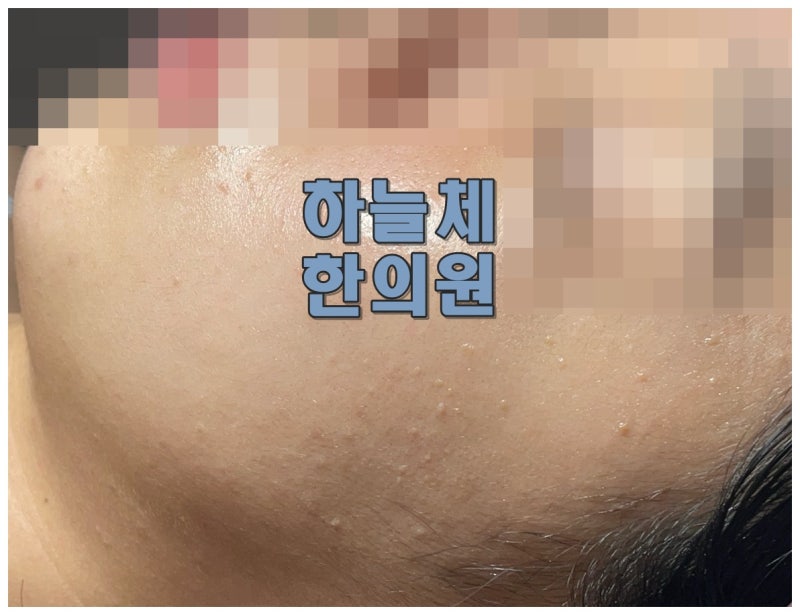 대전편평사마귀제거성지 찾기 전에 비슷해 보이는 질환부터 구분을