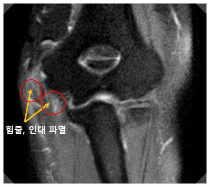 팔꿈치 수술을 해야 한다는데 다른 방법은 없겠죠?