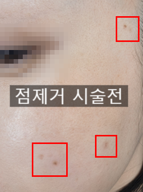 CO2 레이저 후 주의사항｜점·쥐젖·비립종·편평사마귀 제거 후 재생테이프와 딱지 관리