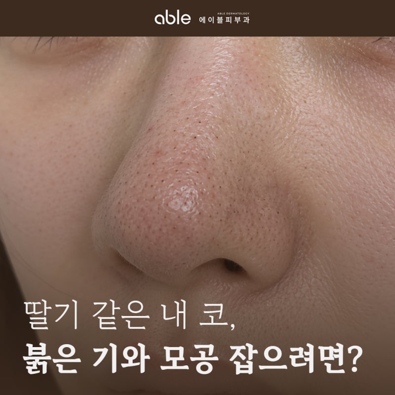 삼전동 피부과 딸기코, 코 붉은기와 모공 같이 잡을 수 있을까요?