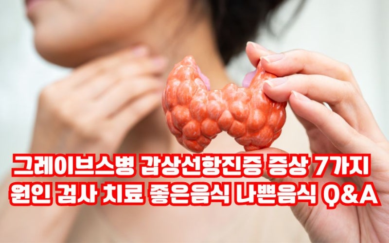 그레이브스병 눈 갑상선항진 증상 7가지 원인 치료 좋은음식 나쁜음식 완치 Q&A
