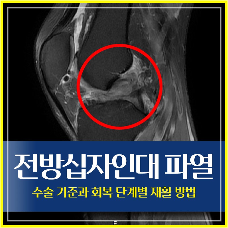전방십자인대 파열 수술 기준과 회복 단계별 재활 방법