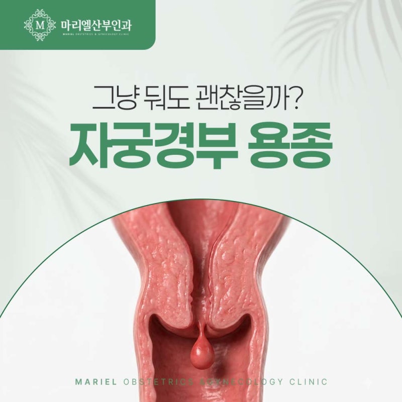 대구 북구 산부인과 검진 중 우연히 발견된 자궁경부 용종 대처법