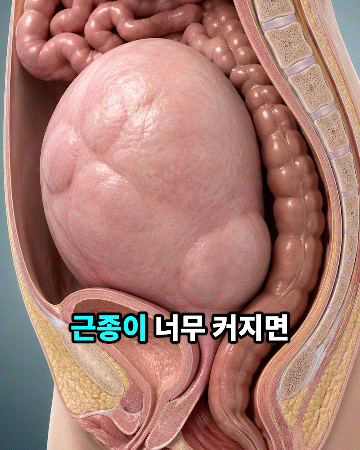 Q. 자궁근종치료, 로봇수술과 하이푸는 어떻게 다른가요? (치료방법/입원/회복/치료 후)
