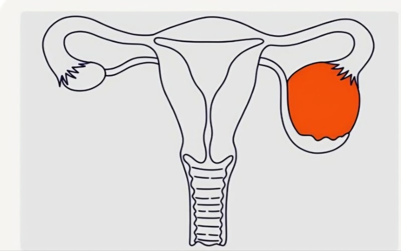 폐경 후 난소낭종, 2개월 만에 커졌다면 난소암일까? 작은 변화에 불안해하는 환자