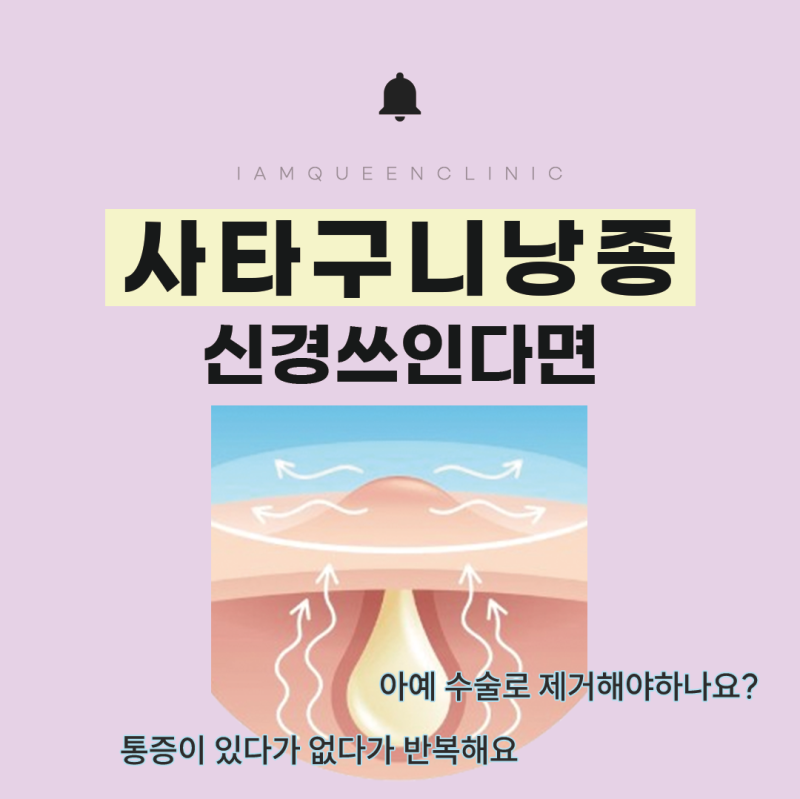 여자 사타구니 낭종, 자꾸 만져지는 멍울이라면? 표피낭종 증상과 치료