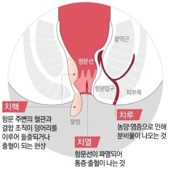 치질증세 ,증상 ,원인, 수술(치핵, 치열, 치루)