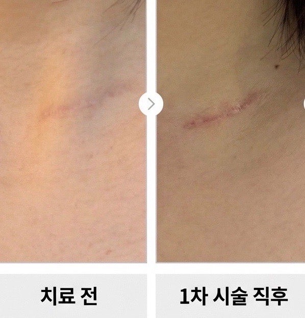 갑상선 수술 흉터 레이저 치료 2회차 후기 (트리필프로, 프락셀, 브이빔 내돈내산 효과)