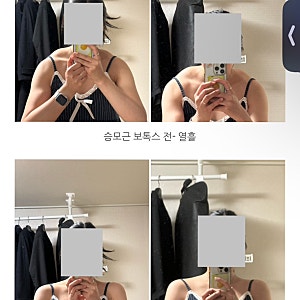 승모근 보톡스 내돈내산 3주차 후기｜300유닛 전후 비교 솔직후기