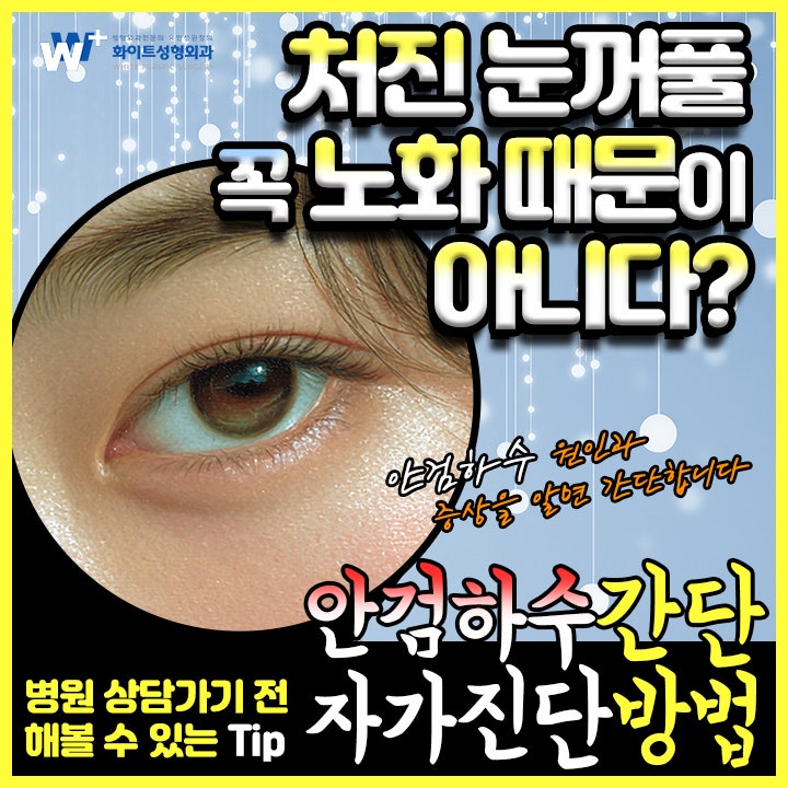 안검하수란? 특징에 따라 다른 안검하수 수술전 자가진단방법