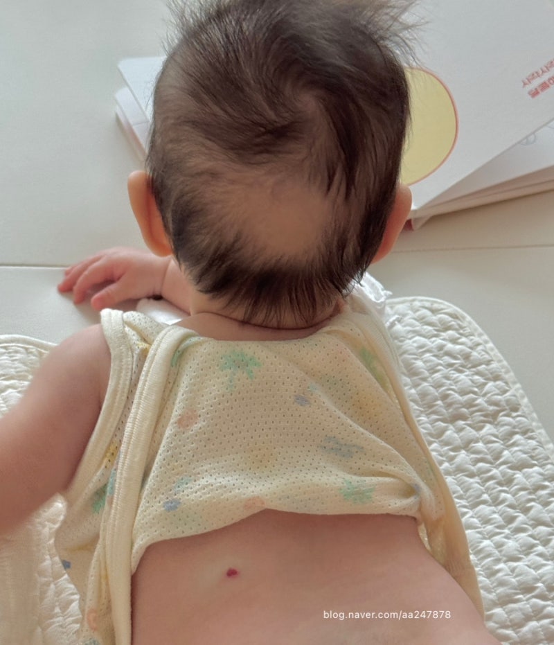신생아 혈관종 마포공덕 에스앤유피부과 실비 주차 레이저 치료 가격 후기