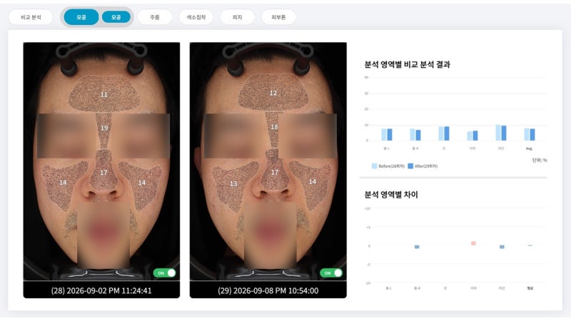 스킨수티컬즈 CE 페룰릭, 아렌시아 비타민C vs 리쥬란 PDRN 모공 라인, 3주 차 효과 비교 - 4편