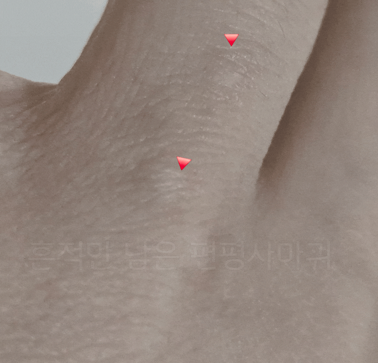 편평사마귀 셀프 관리, 제가 직접 해본 녹차·율무 팩 이야기