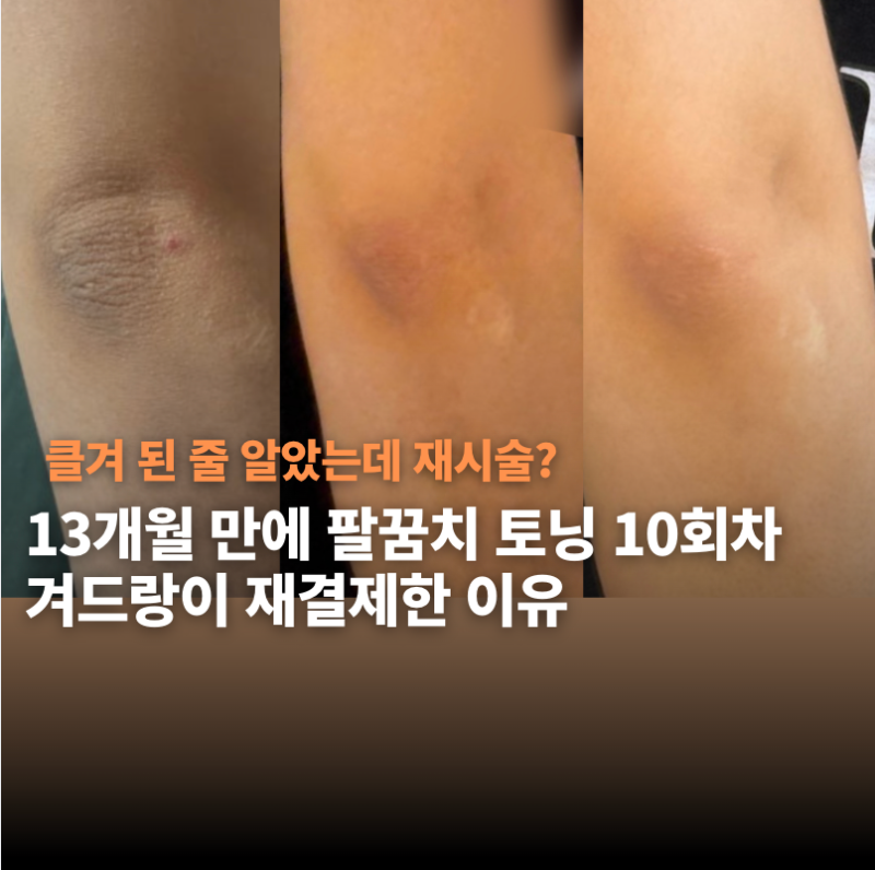 팔꿈치 착색 레이저 9,10회차 | 클겨 판정받은 겨드랑이 다시 결제한 이유 (+피코토닝 가격, 내....