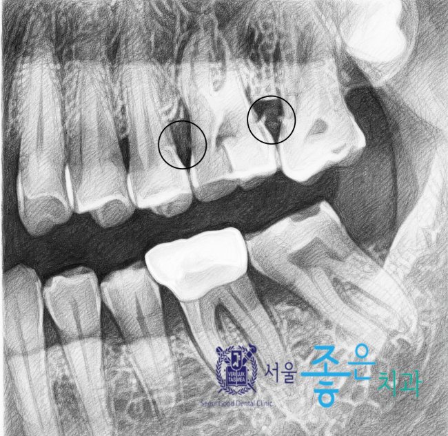 양치할때 피 난다면? 통증없이 시작되는 만성 치주염 - 잇몸치료 방법, 비용, 잇몸치료 후 시....